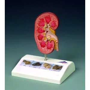 Lippincott Williams + Wilkins Kidney Stone Model:  