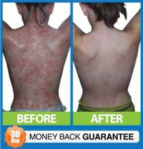 Get rid of Eczema / Dermatitis once and forever ***  
